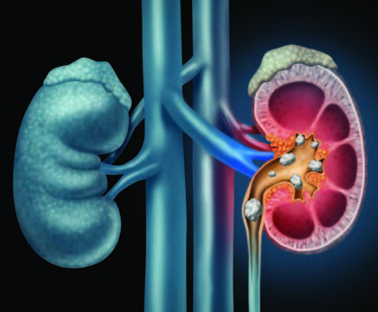 entered a new era of highly effective, noninvasive procedures. We bring you up to date on kidney stone treatment & prevention