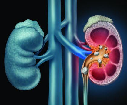 Kidney Stones Treatment Prevention Specialdocs Consultants